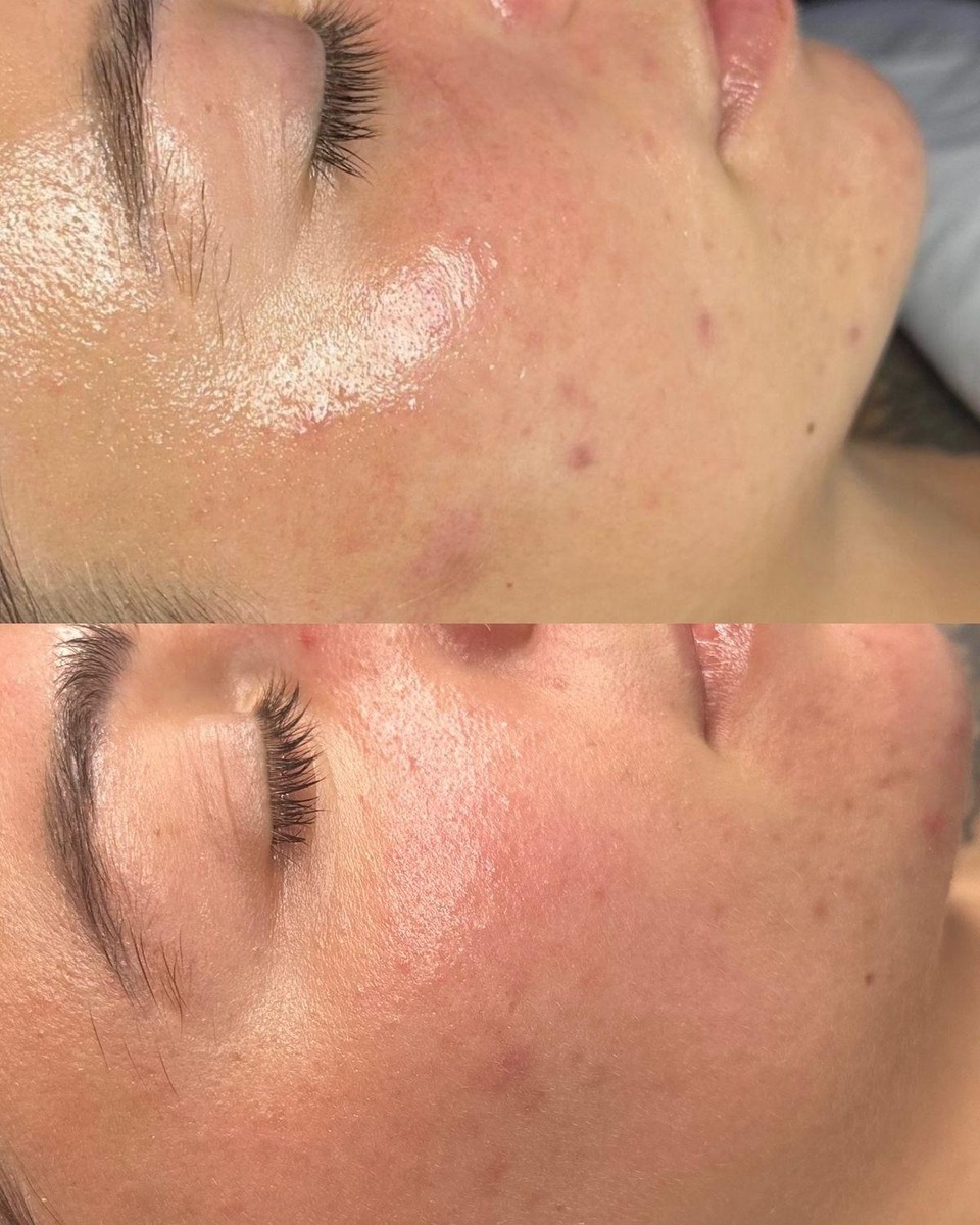 Before after skin