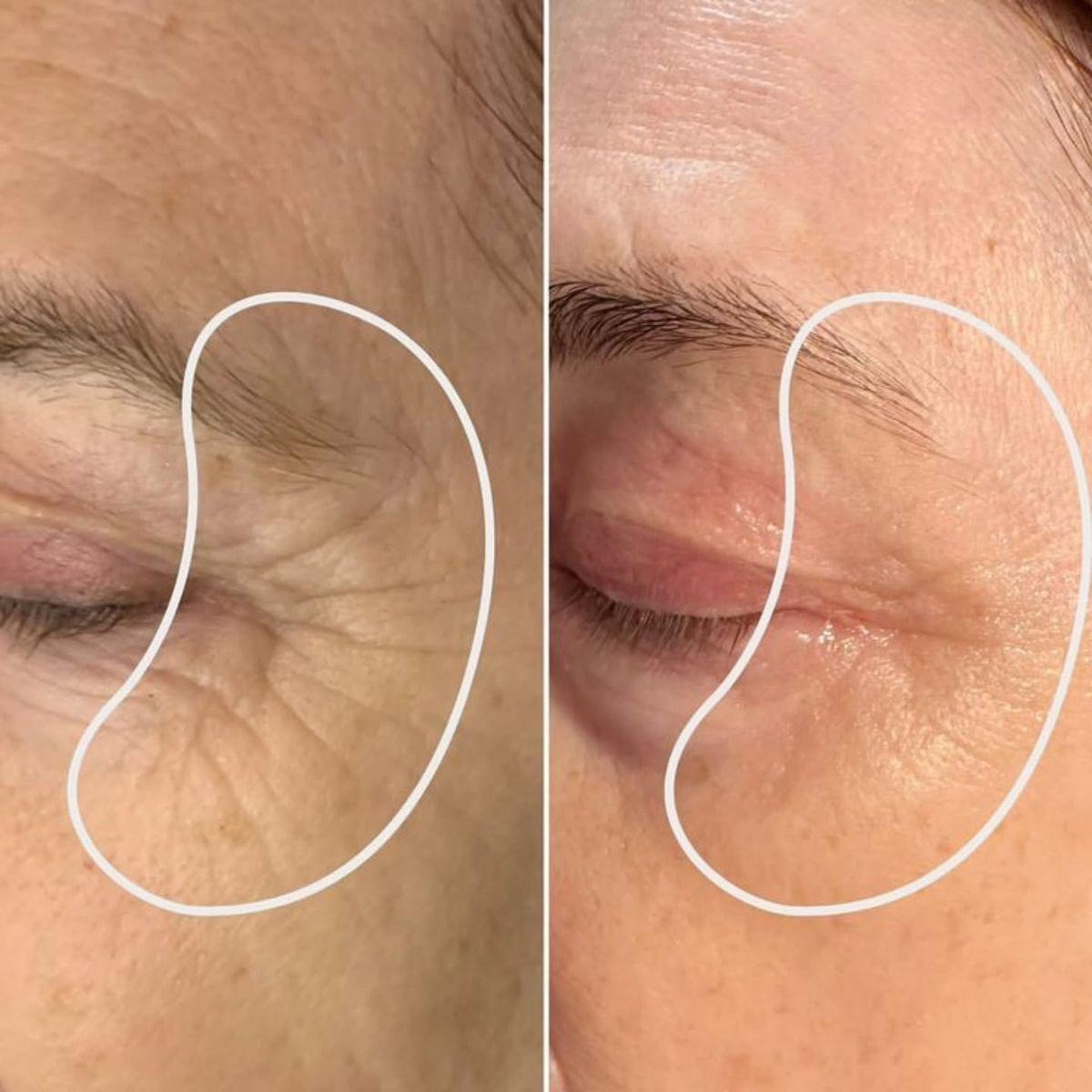 Eye firming